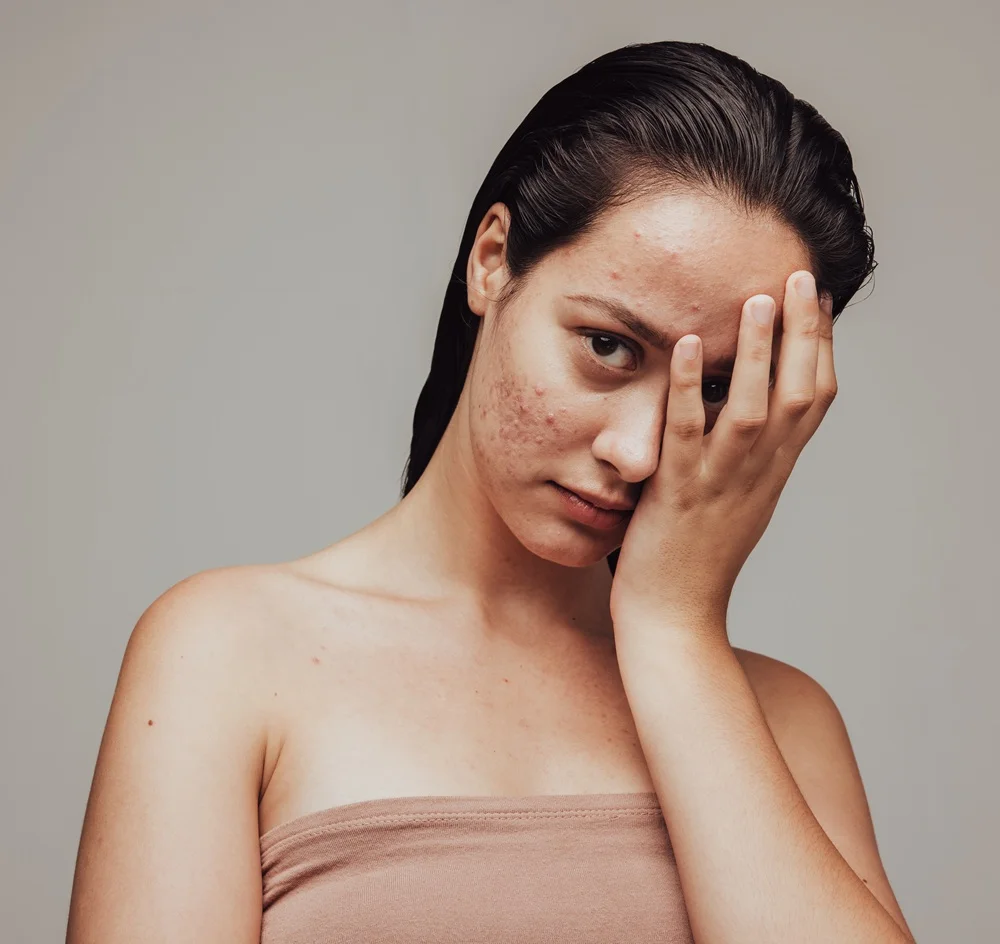 Acne Treatments 1 real results medical aesthetics acne new | Acne Treatments