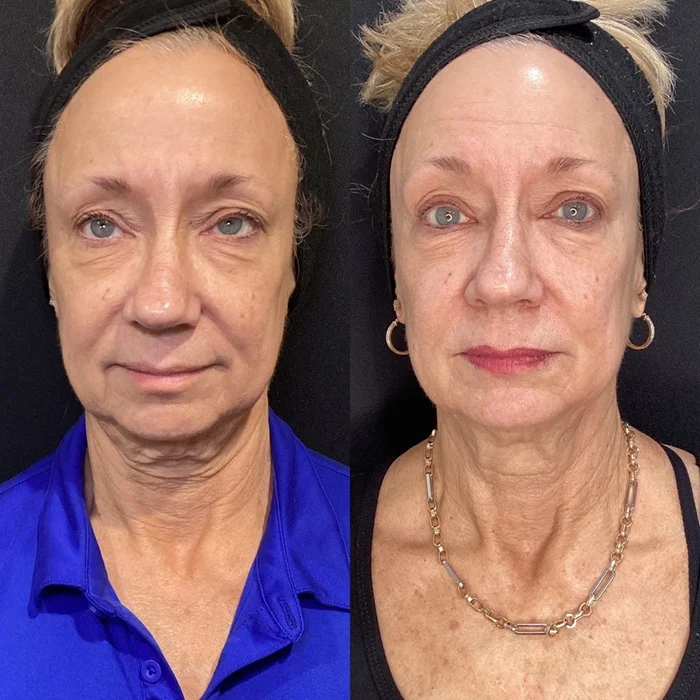 Results 3 Real Results Medical & Aesthetics Clear Skin Before After G