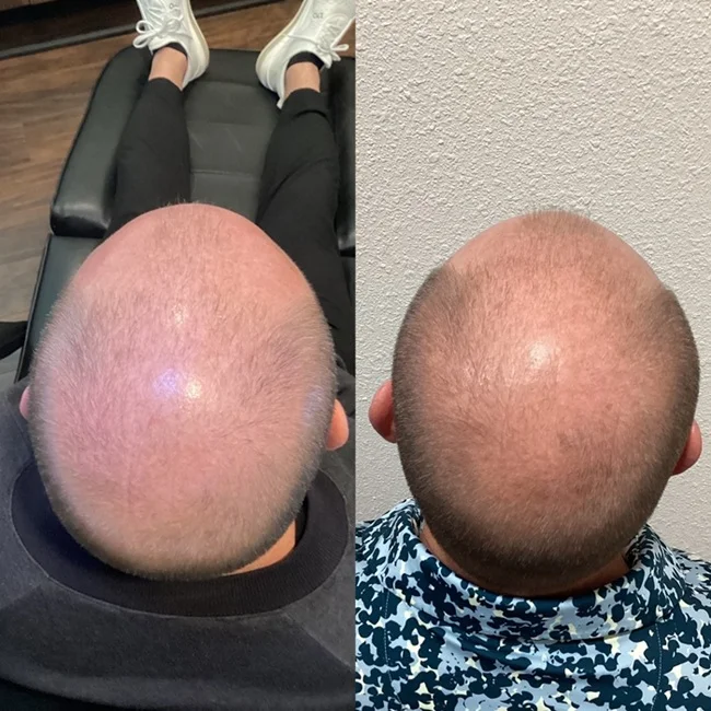 Results 47 Real Results Medical & Aesthetics Hair Loss Ted A