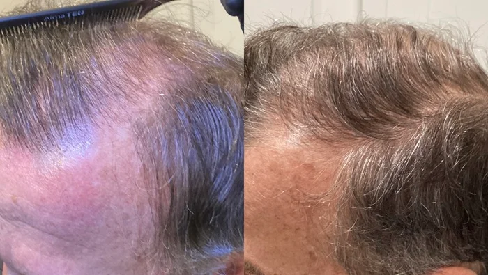 Results 48 Real Results Medical & Aesthetics Hair Loss Ted B
