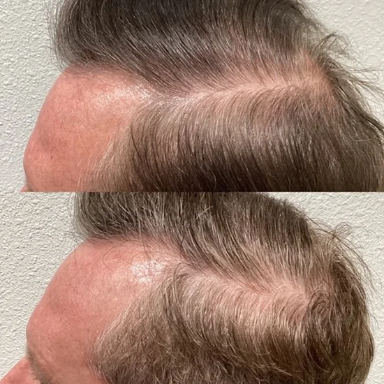 Results 46 Real Results Medical & Aesthetics Hair Loss Ted C