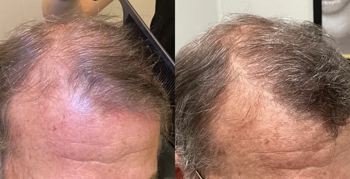 Results 49 Real Results Medical & Aesthetics Hair Loss Ted D