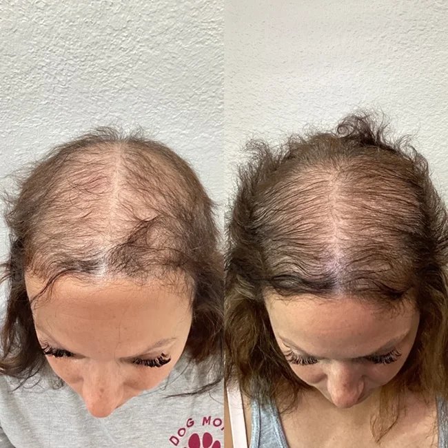 Results 50 Real Results Medical & Aesthetics Hair Loss Ted F