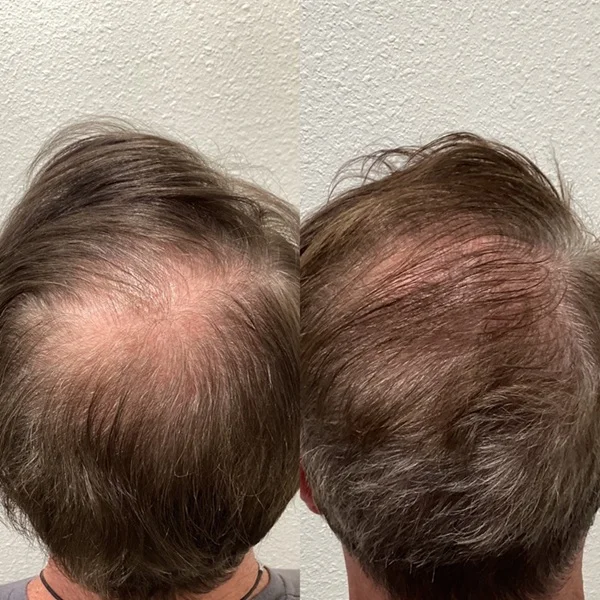 Results 51 Real Results Medical & Aesthetics Hair Loss Ted G