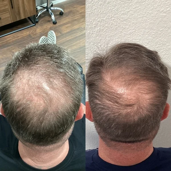 Results 52 Real Results Medical & Aesthetics Hair Loss Ted G