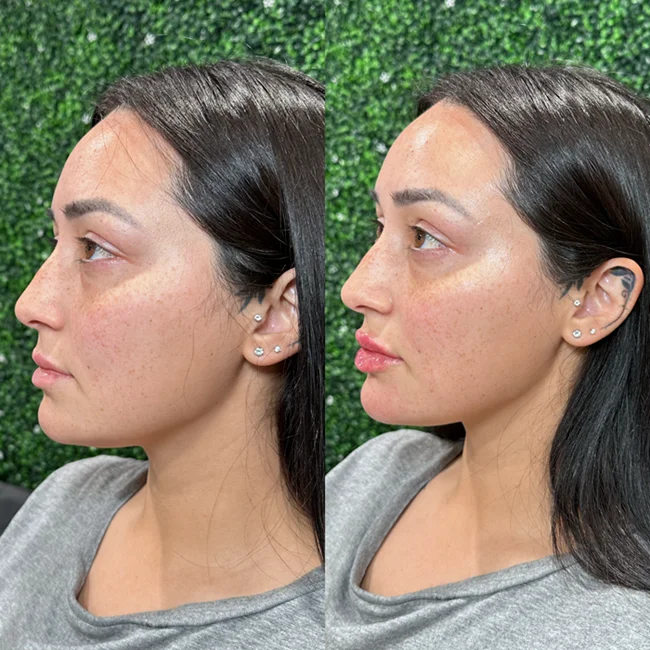 Results 23 Real Results Medical & Aesthetics Injectables Before After