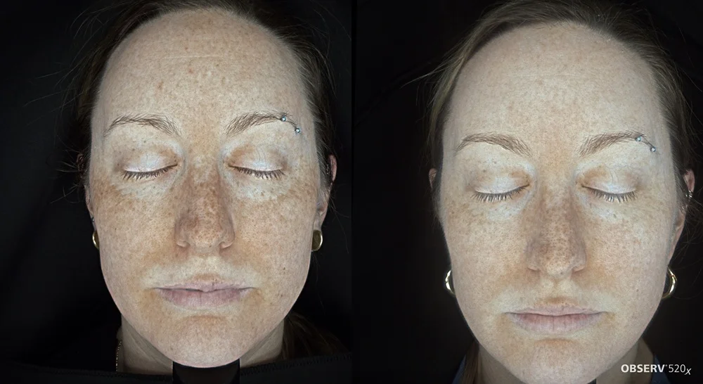 Results 26 Real Results Medical & Aesthetics IPL Before After A