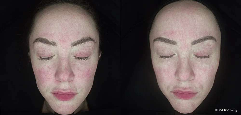 Results 29 Real Results Medical & Aesthetics IPL Before After B