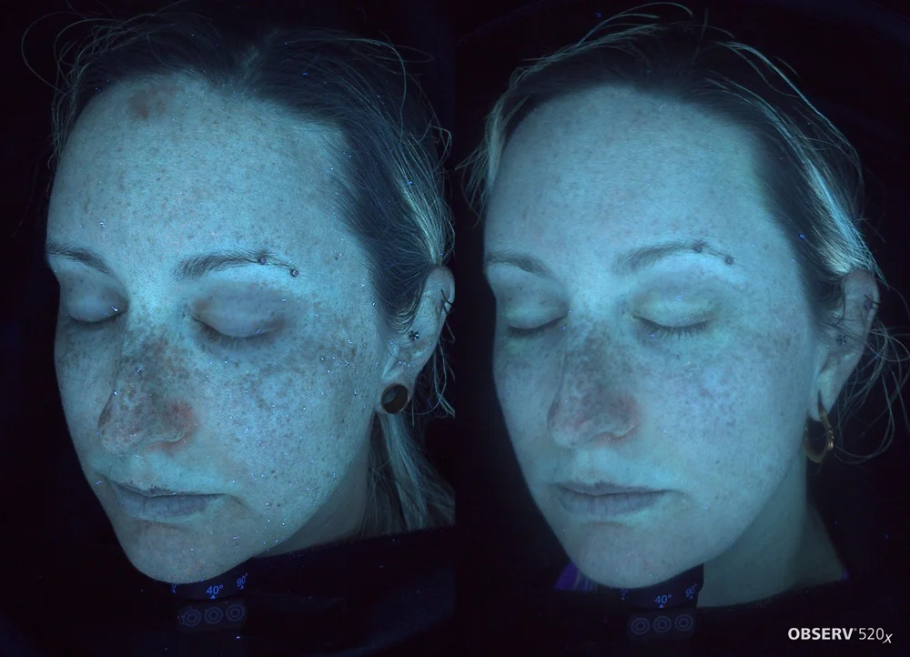 Results 28 Real Results Medical & Aesthetics IPL Before After D