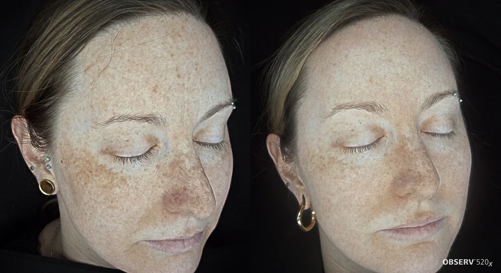 Results 27 Real Results Medical & Aesthetics IPL Before After E