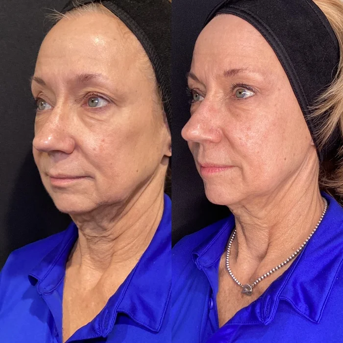 Results 38 Real Results Medical & Aesthetics Opus Before After B
