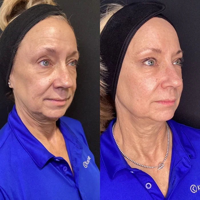 Results 33 Real Results Medical & Aesthetics Opus Before After E
