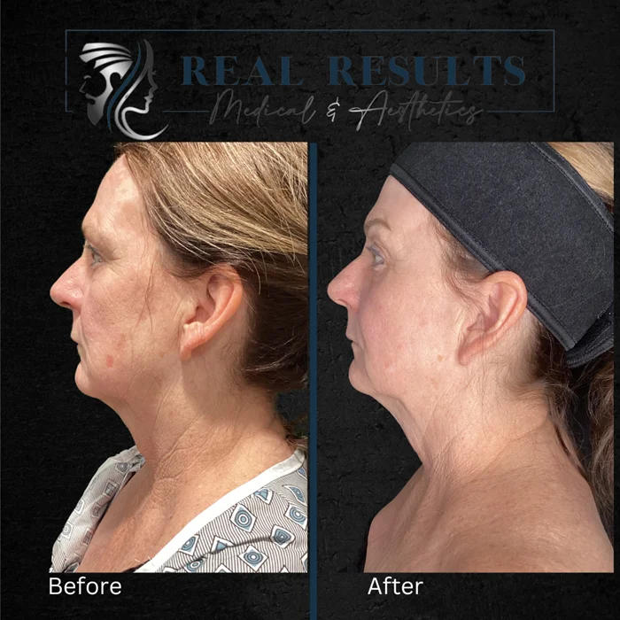 Results 31 Real Results Medical & Aesthetics Opus Before After K