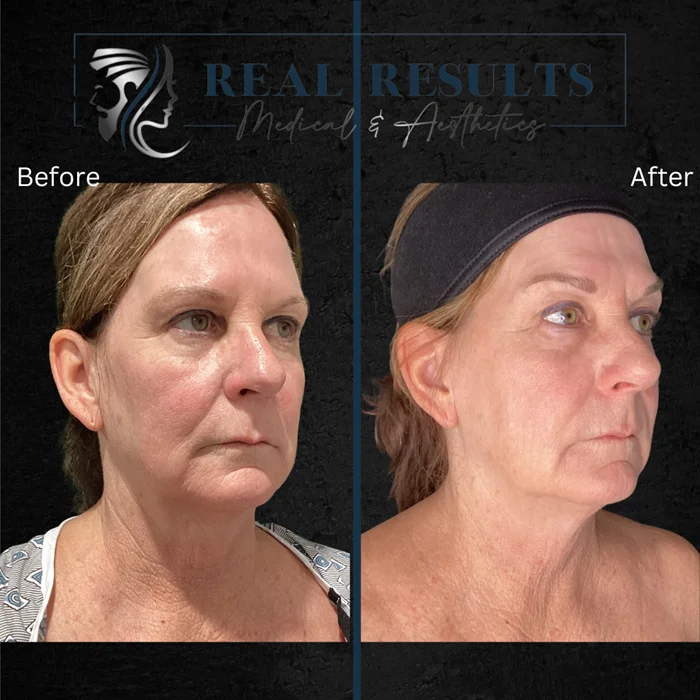 Results 32 Real Results Medical & Aesthetics Opus Before After L
