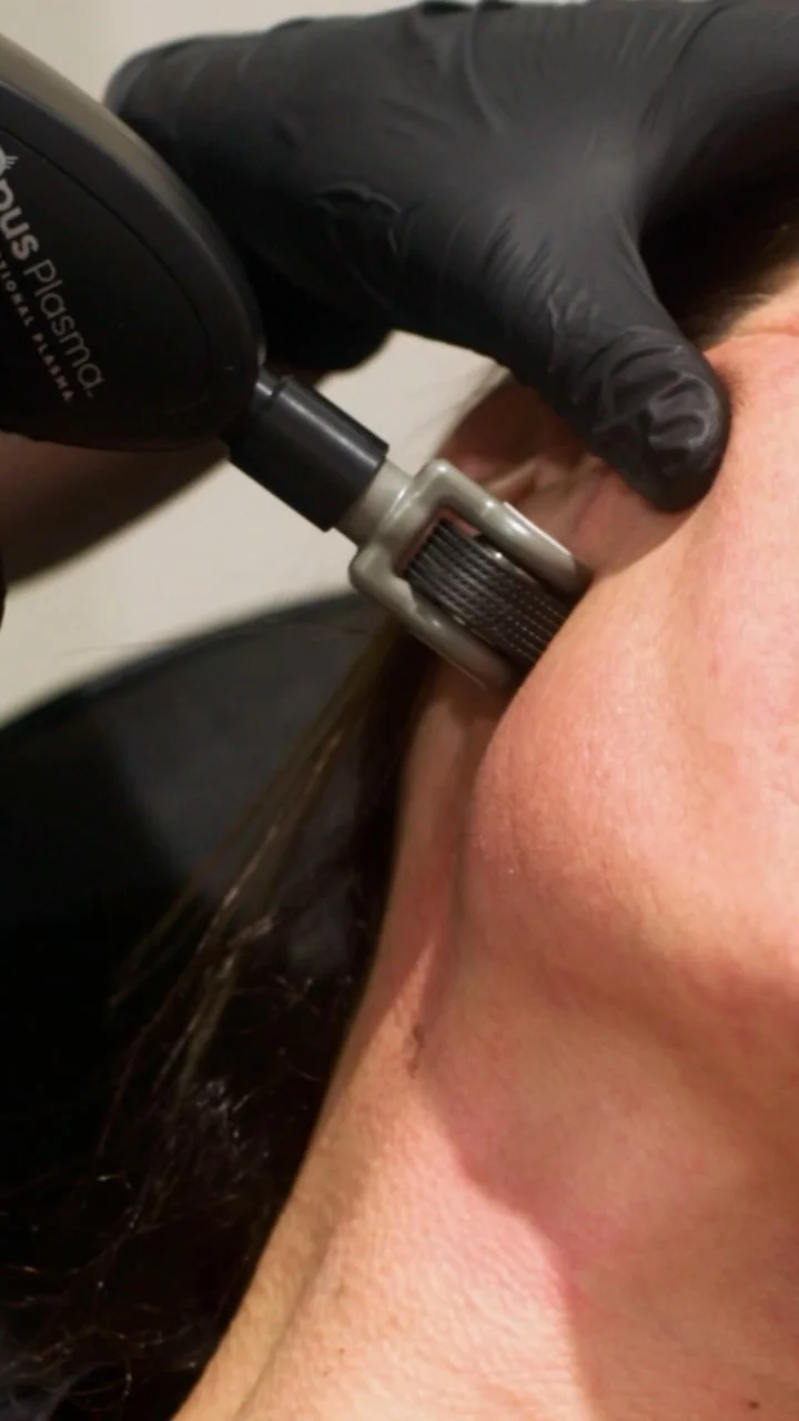 Opus Plasma® Skin Resurfacing with RF 1 real results medical aesthetics opus plasma | Opus Plasma® Skin Resurfacing with RF