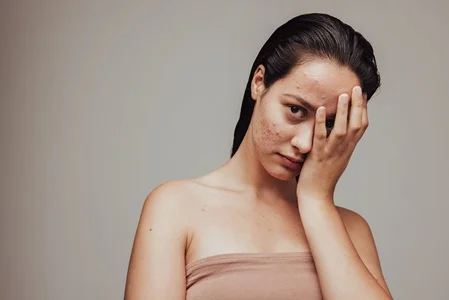 real results medical aesthetics acne services | Conditions