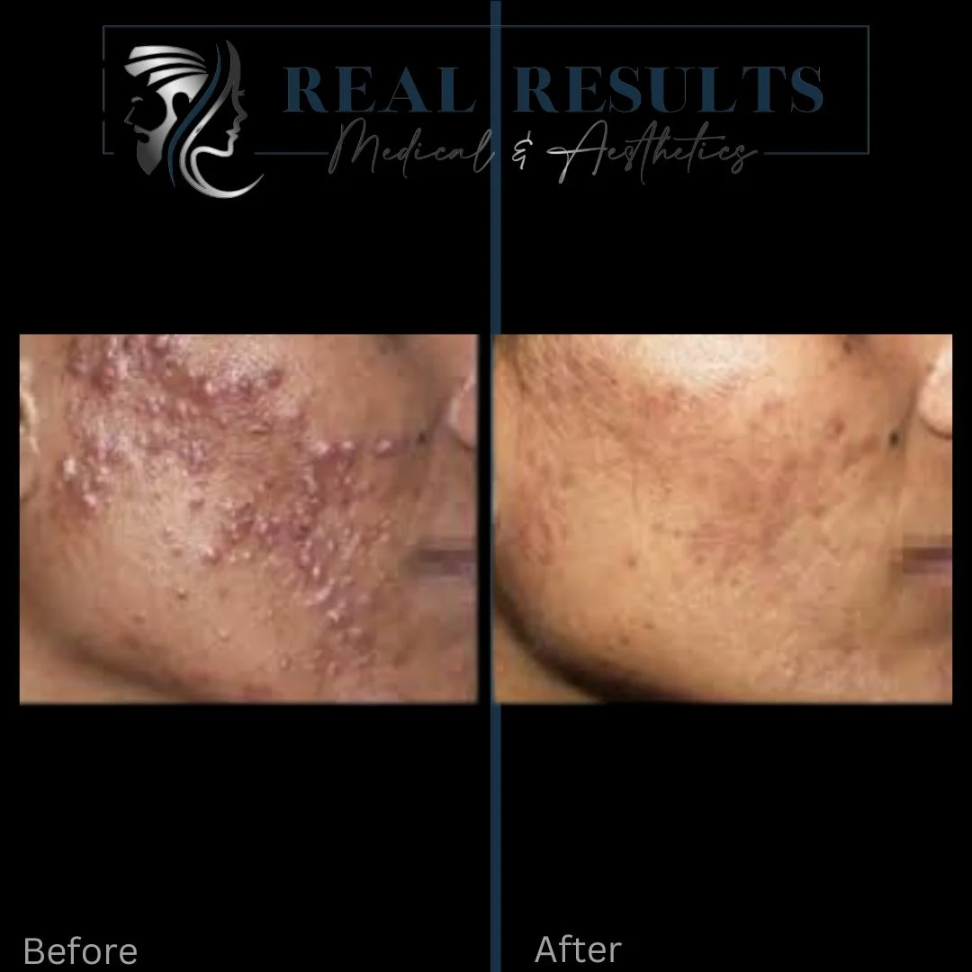Results 1 Real Results Medical & Aesthetics Clear Skin A