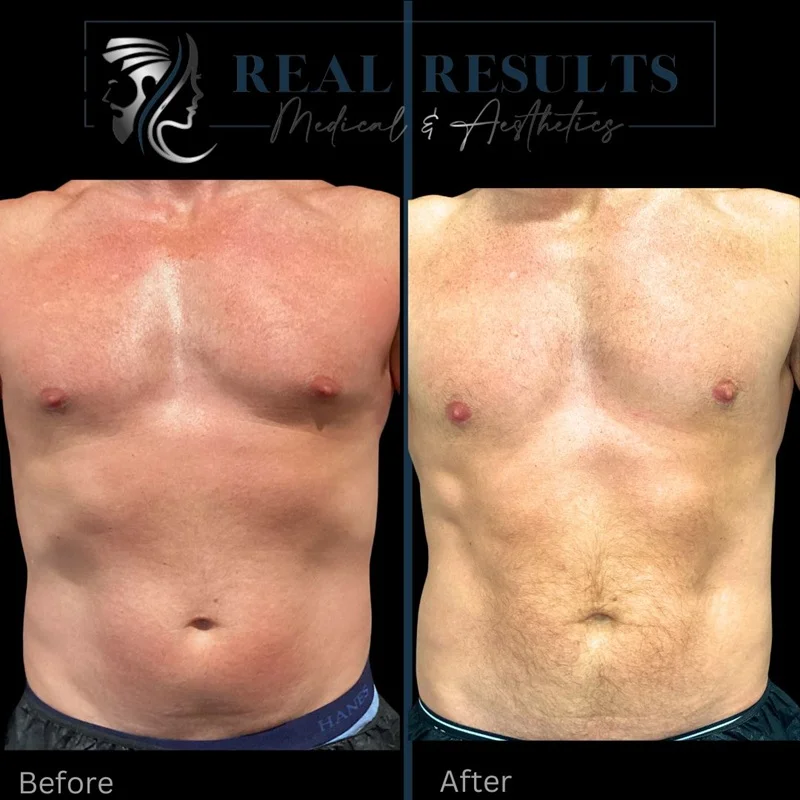 Results 4 Real Results Medical & Aesthetics Emsculpt A