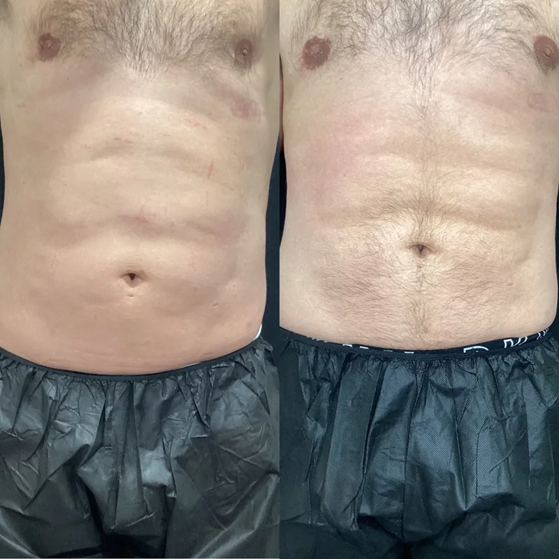 Results 11 Real Results Medical & Aesthetics Emsculpt B