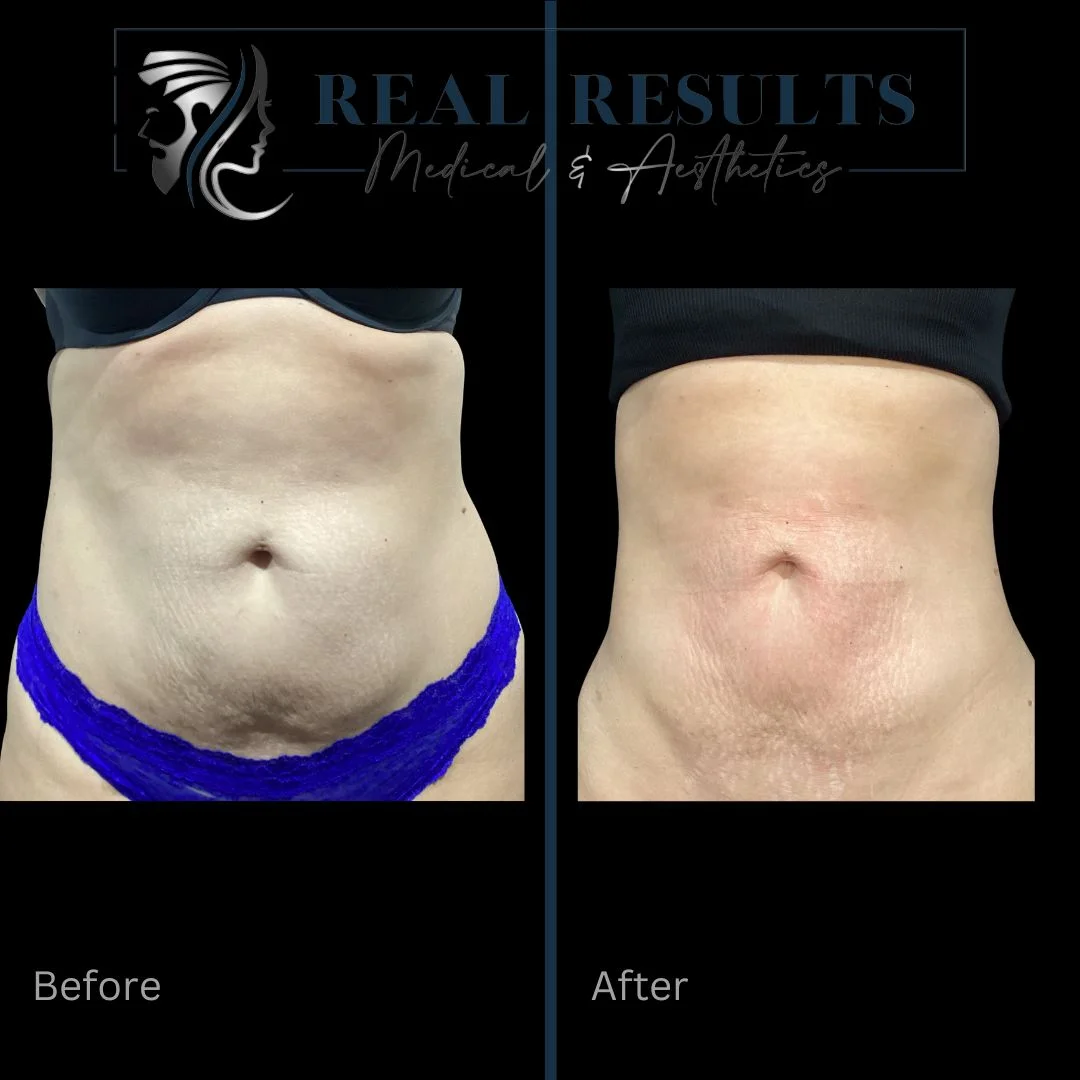 Results 6 Real Results Medical & Aesthetics Emsculpt C