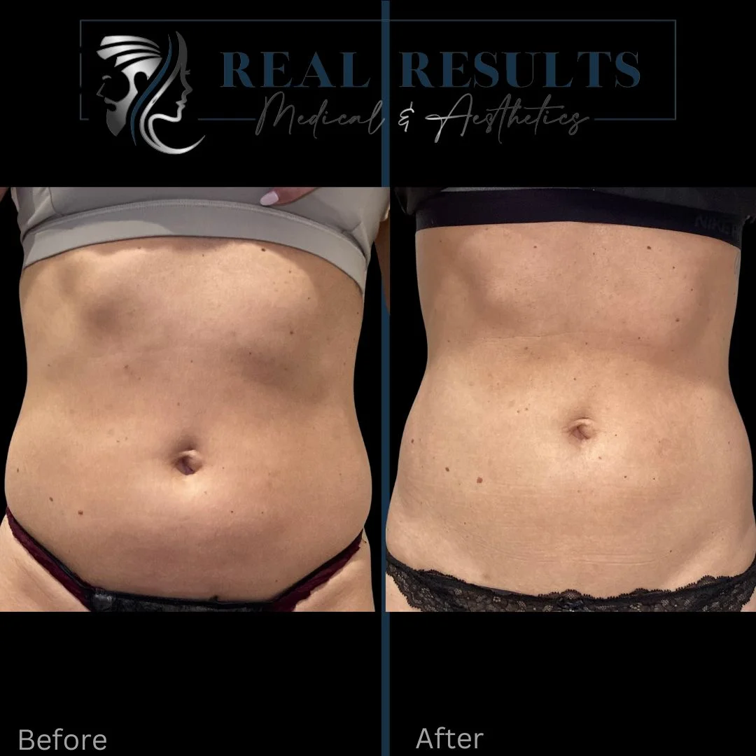 Results 7 Real Results Medical & Aesthetics Emsculpt D