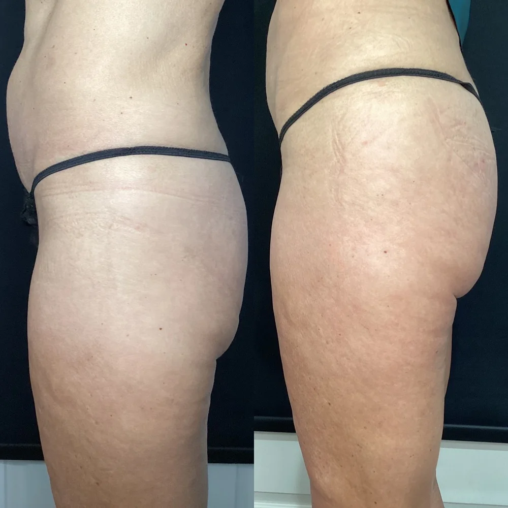 Results 10 Real Results Medical & Aesthetics Emsculpt F
