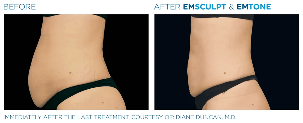 Results 13 Real Results Medical & Aesthetics Emsculpt G