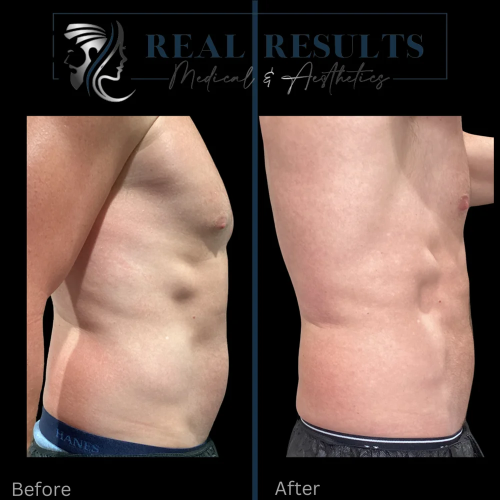 Results 8 Real Results Medical & Aesthetics Emsculpt H