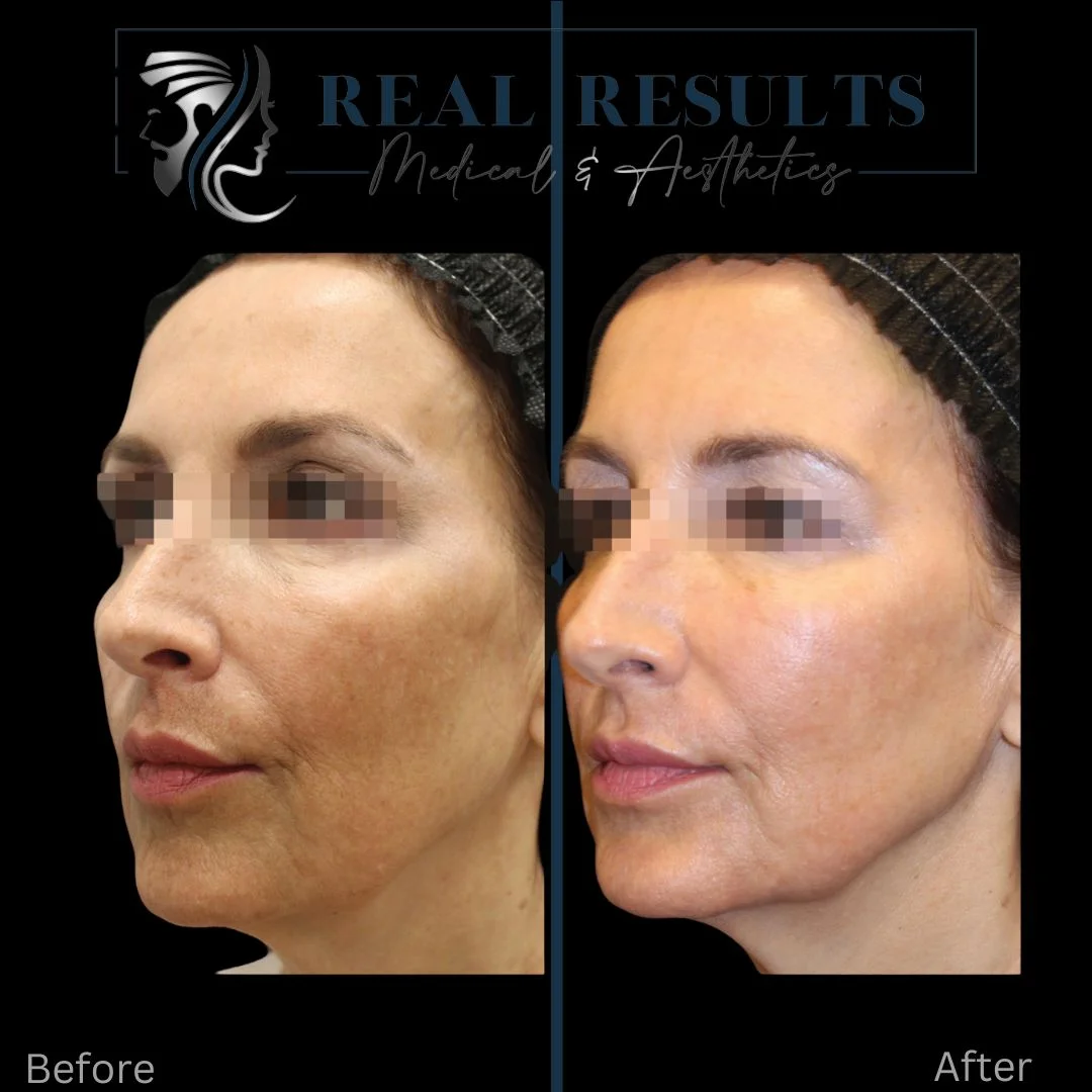 Results 25 Real Results Medical & Aesthetics IPL A