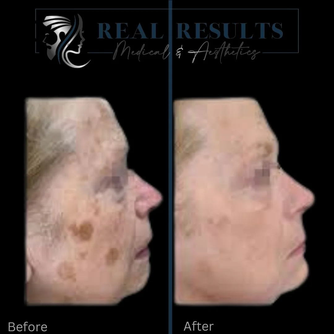 Results 24 Real Results Medical & Aesthetics IPL B