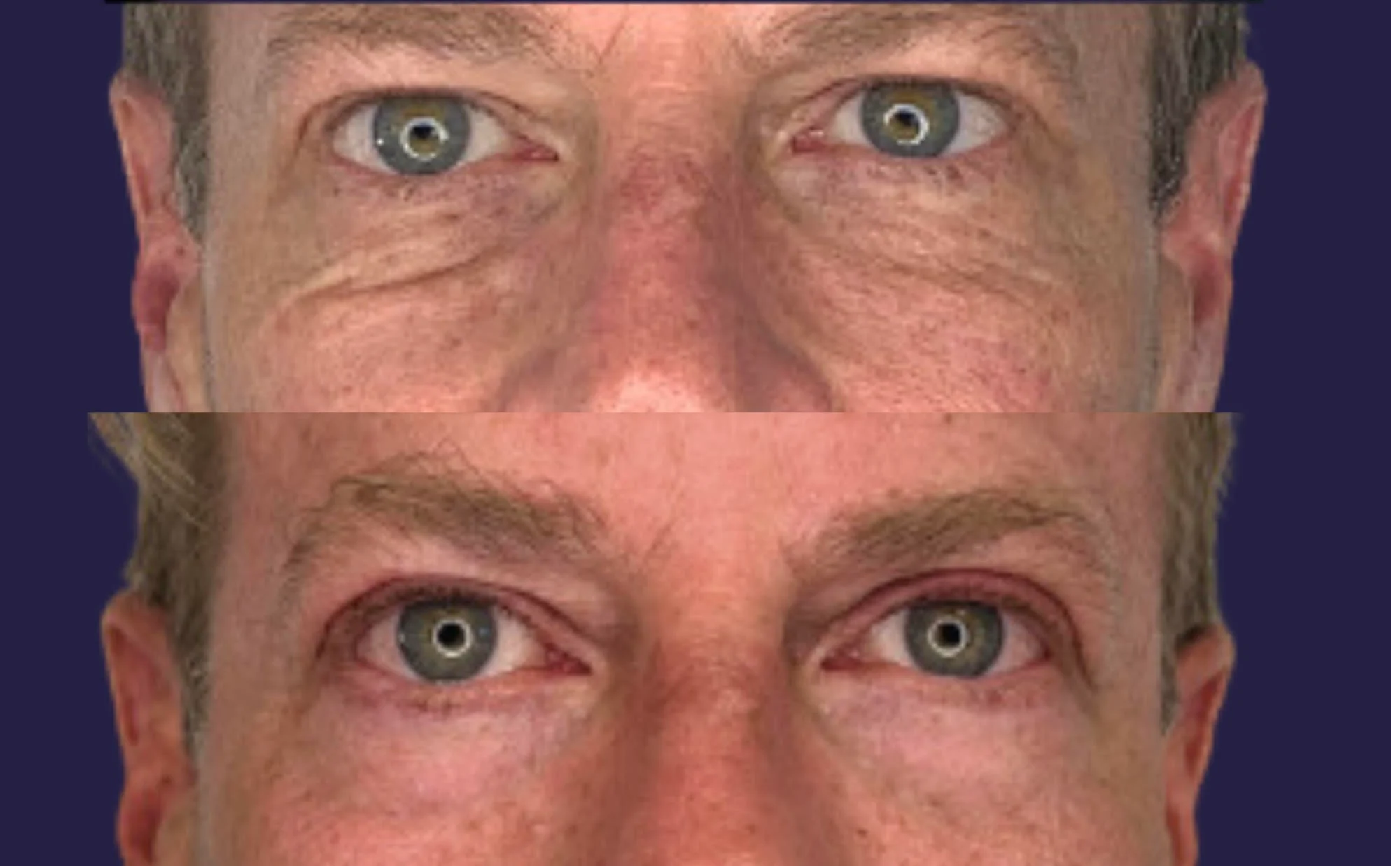 Results 42 real results medical aesthetics opus colibri a | Results