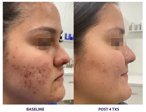 Results 39 Real Results Medical & Aesthetics Opus Colibri B