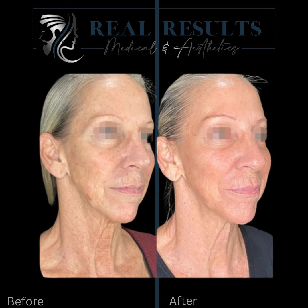 Results 35 Real Results Medical & Aesthetics Opus Colibri C