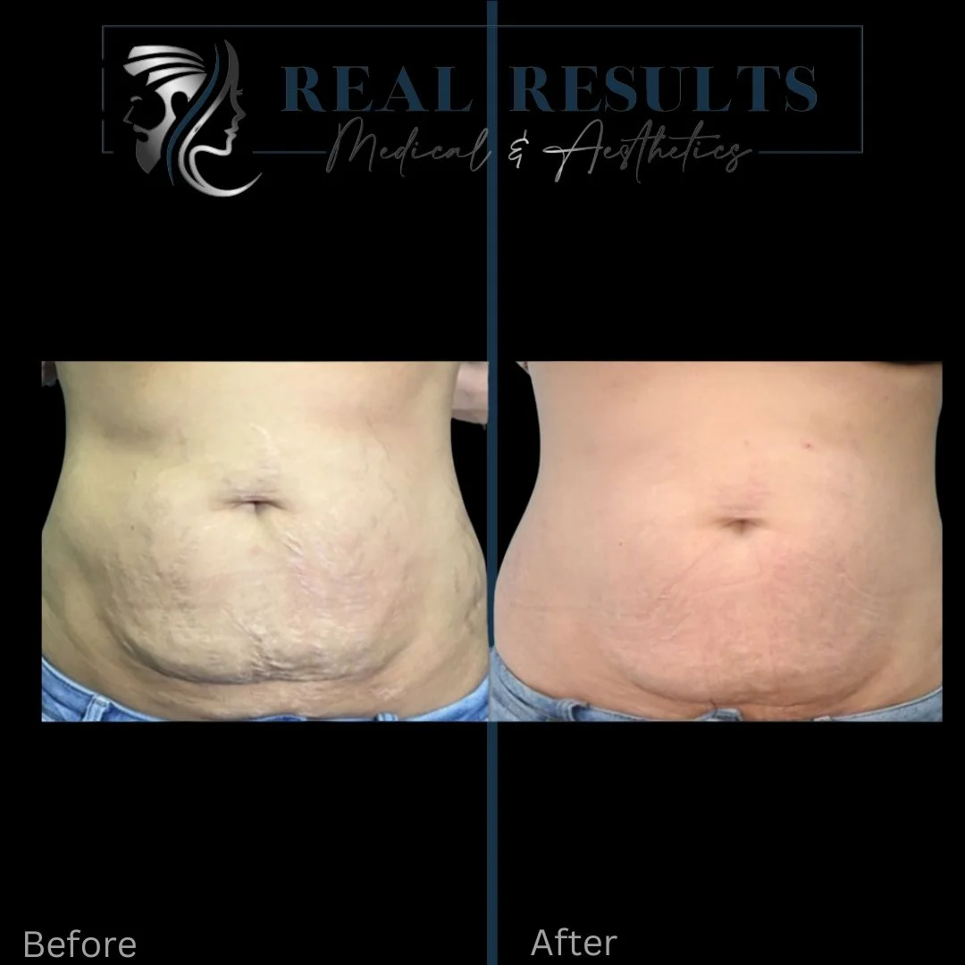 Results 36 Real Results Medical & Aesthetics Opus Colibri D