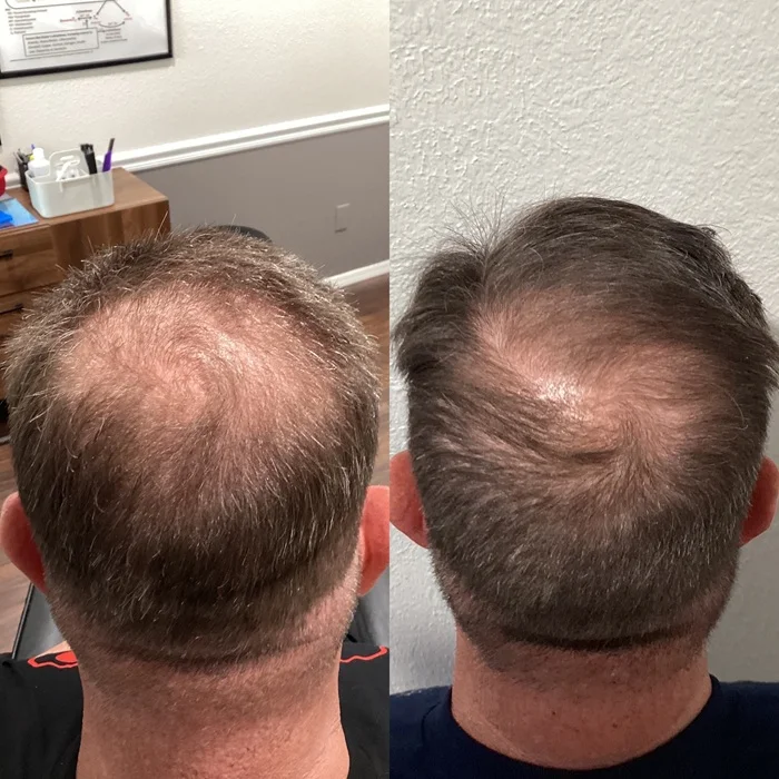 Real Results Medical & Aesthetics Hair Loss Ted E