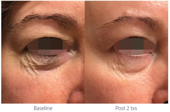 Real Results Medical & Aesthetics Opus Before After C