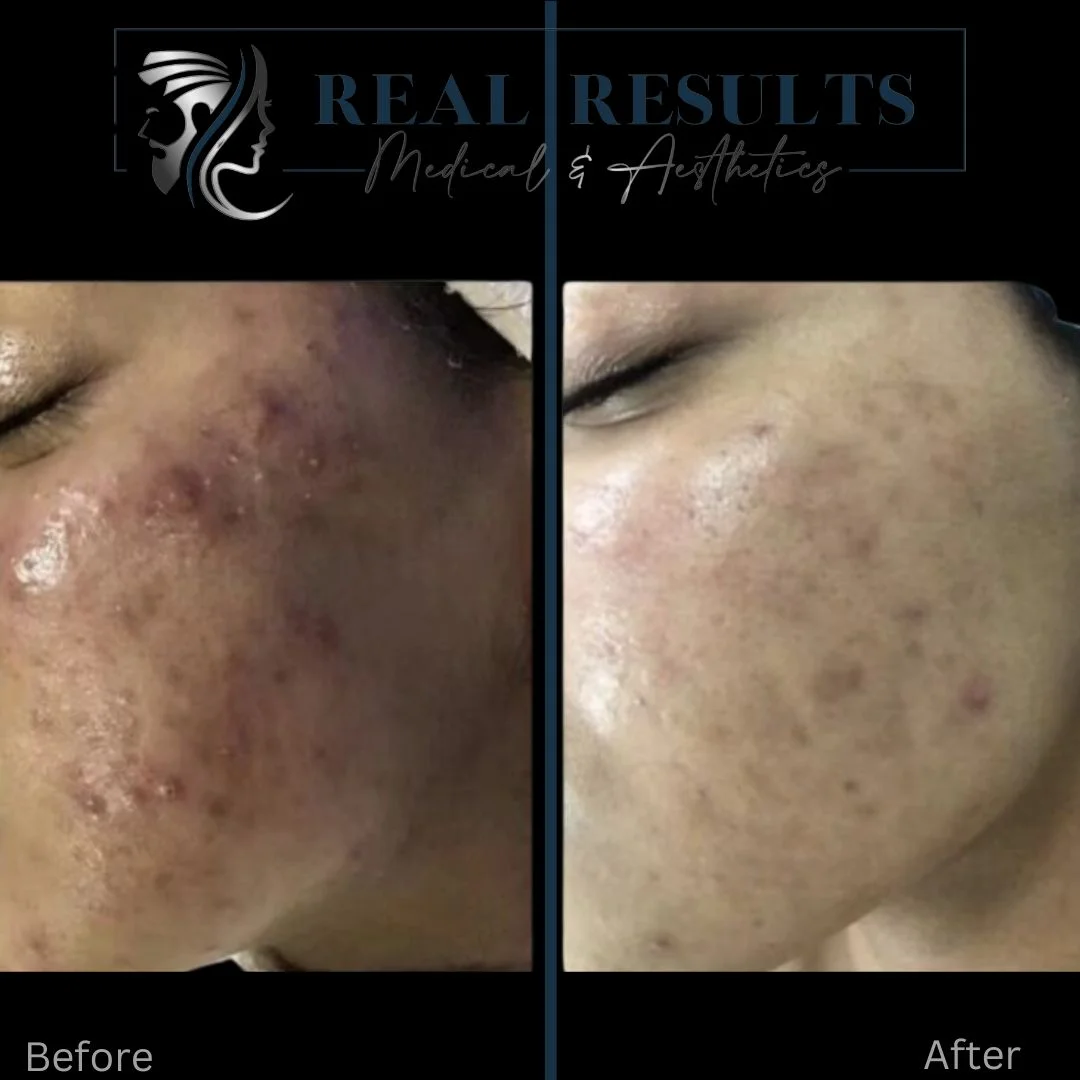 Real Results Medical & Aesthetics Clear Skin B